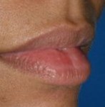 Avant diminution des lèvres