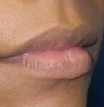After Lip Reduction