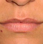 Avant augmentation des lèvres par injection de graisse autologue