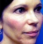 Avant lifting du visage (Vampire lift)
