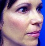 Après lifting du visage (Vampire lift)