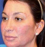 Après lifting du visage PRP (Vampire lift)