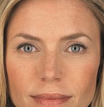 After a liquid facelift with injectables