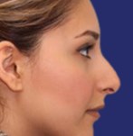 Face before rhinoplasty with prominent nasal bridge