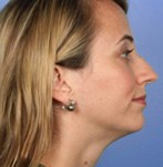 Before refining nose tip