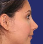 Result after rhinoplasty with smoother, balanced nasal line
