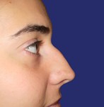 Profile before rhinoplasty, visible nasal deviation
