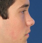 Vor der Korrektur von Nasenspitze und Nasenrücken