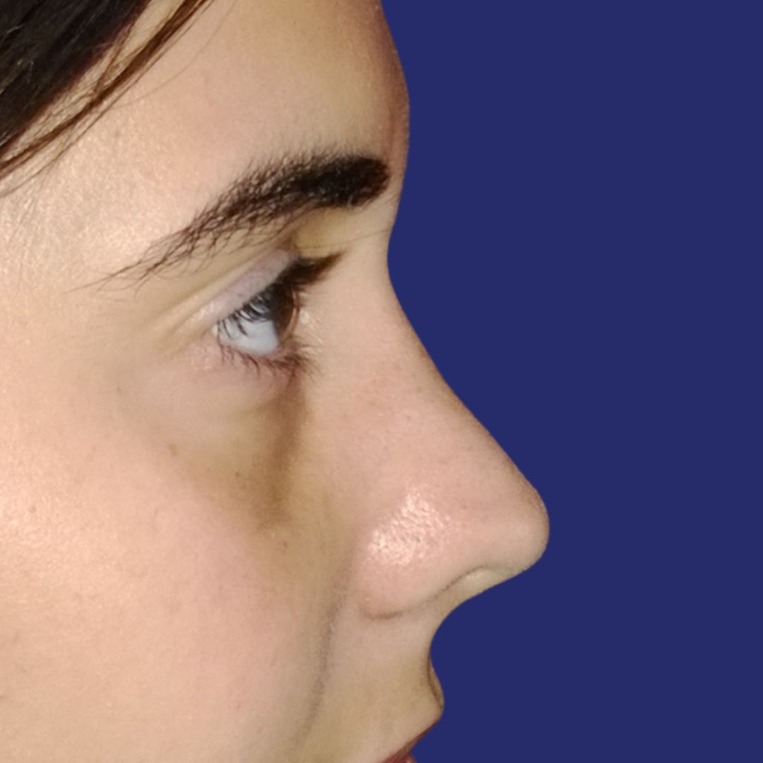 Na operatie, rechte en symmetrische neus na esthetische neuscorrectie