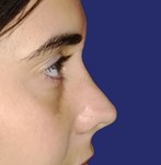 After surgery, straight and symmetric nose following rhinoplasty