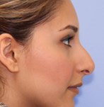 Vor Verfeinerung der Nasenspitze und Korrektur des Nasenrückens