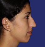 Before refining the nose tip and correction nose bridge