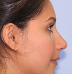 Nach Verfeinerung der Nasenspitze und Korrektur des Nasenrückens