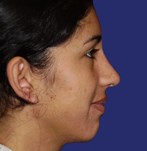 After refining nose tip and correcting nose bridge