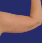 Vor der Fettabsaugung am Arm
