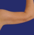 Nach der Fettabsaugung am Arm
