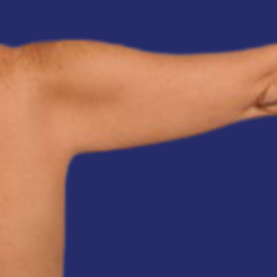 Before Arm Lipo
