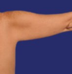 Vor Fettabsaugung am Arm