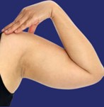 Vor Fettabsaugung am Arm