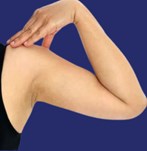 Nach Fettabsaugung am Arm