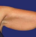 Before Armlift surgery