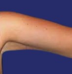 After Armlift Surgery
