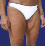Avant lifting des cuisses : élimination de l'excédent de peau de la partie supérieure des jambes