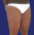 Après lifting des cuisses élimination de l'excédent de peau de la partie supérieure des jambes