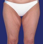 Pour lifting des cuisses : image frontale d’un patient présentant une peau relâchée et un excès de graisse à l’intérieur des cuisses.