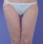 Oberschenkel Lifting Was Sie Erwartet Wellness Kliniek
