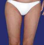 Après le lifting des cuisses : image frontale montrant des jambes fermes avec un contour mieux défini.