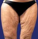 Pour chirurgie de lifting des cuisses : patient avec un excès de peau et une accumulation de graisse dans la partie supérieure des cuisses.