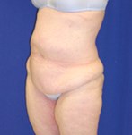 Before removal of excess skin upper legs combined with body lift