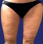 Résultat du lifting des cuisses : patient avec une peau plus tendue et des contours corporels améliorés à l’intérieur des cuisses.