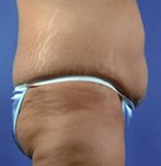 Vor der Abdominoplastik