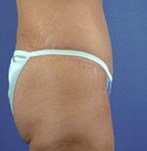 Après abdominoplastie