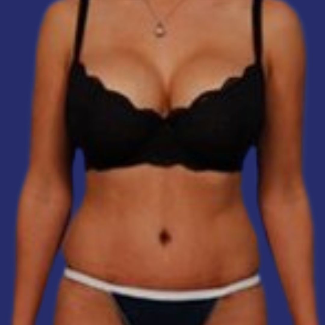 After tummy tuck to achieve a firmer and more aesthetic abdomen