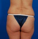 Before Lifting the Buttocks with Implants