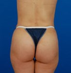 After Lifting the Buttocks with Implants