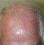 Before Hair Transplantation