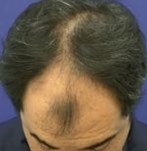 Before Hair Transplant