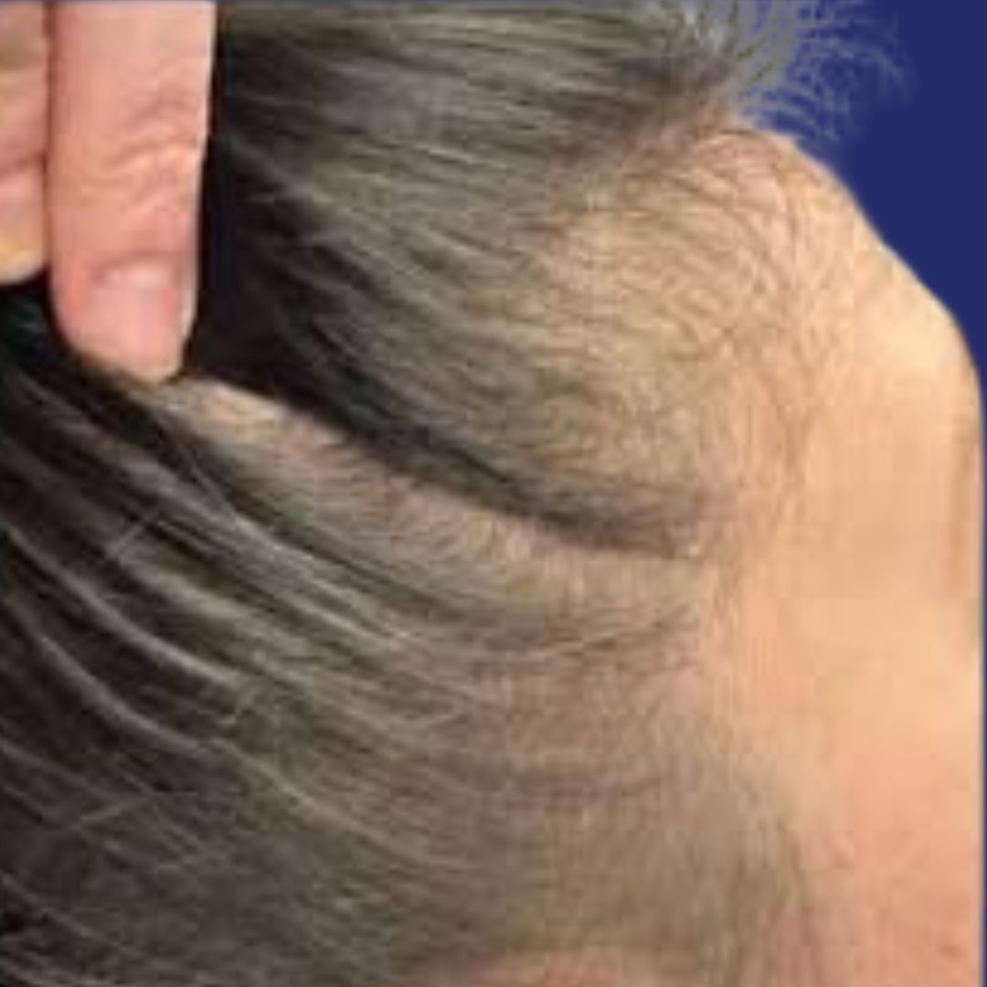 Before PRP hair loss treatment: thinning hair and reduced scalp density