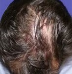 Before PRP Hair Loss Therapy