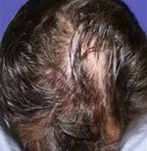 Vor der PRP-Haartherapie
