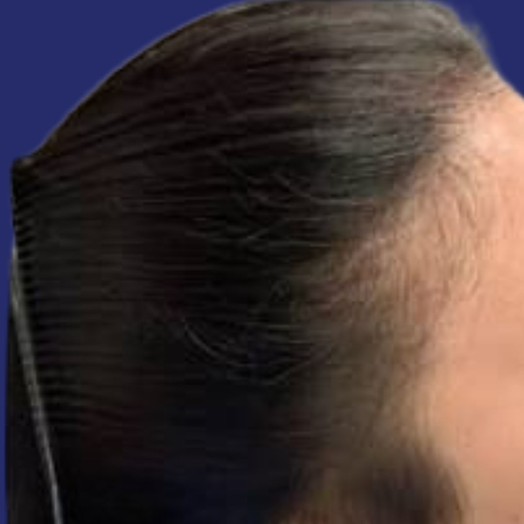 After PRP hair restoration: visibly fuller hair and improved scalp density