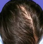 After PRP Hair Loss Therapy