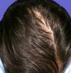 Nach der PRP-Haartherapie