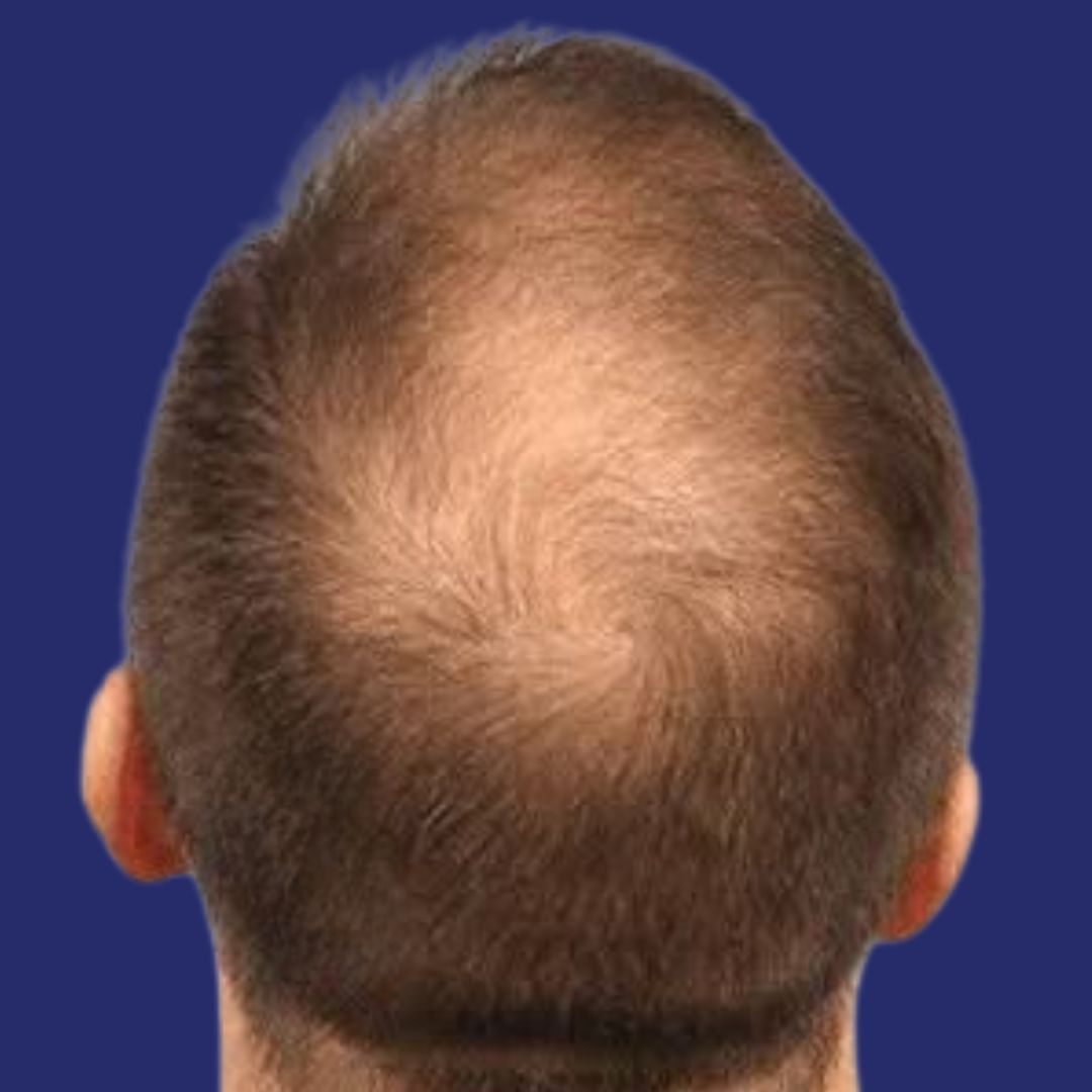 Before Hair Therapy with PRP