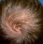 Vor der Haartherapie mit PRP