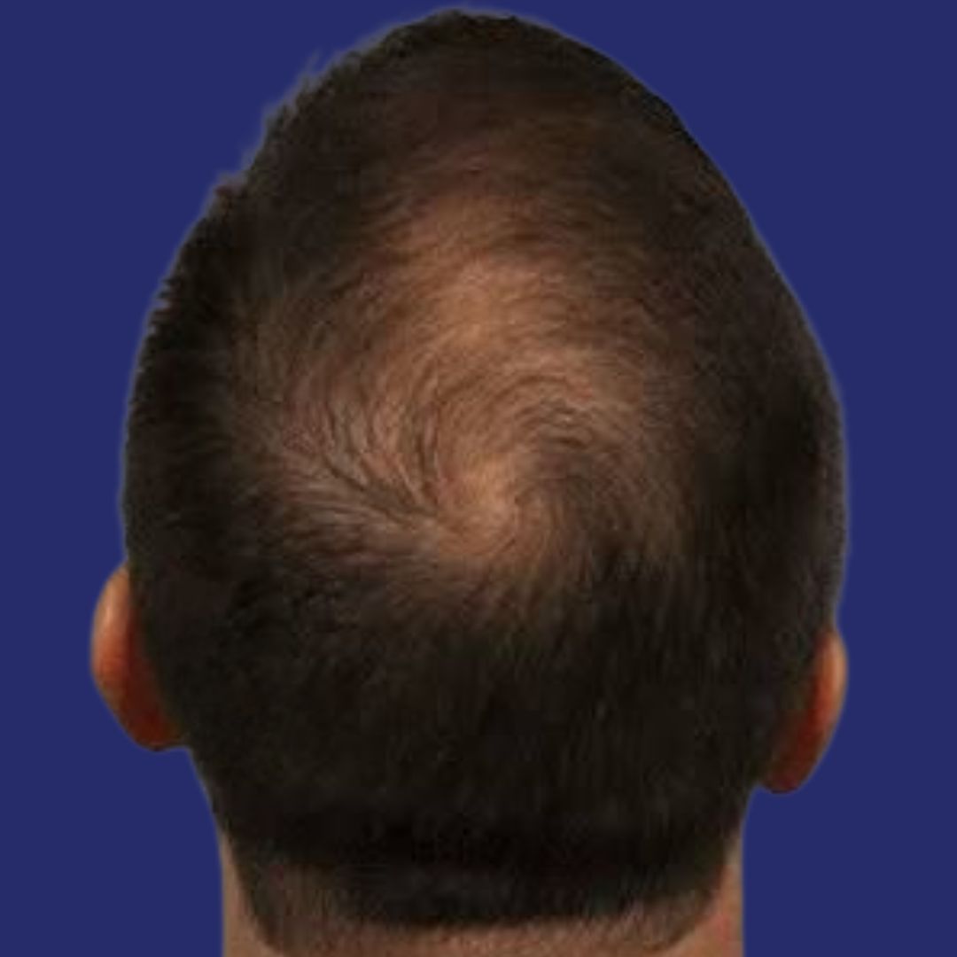 After Hair Therapy with PRP